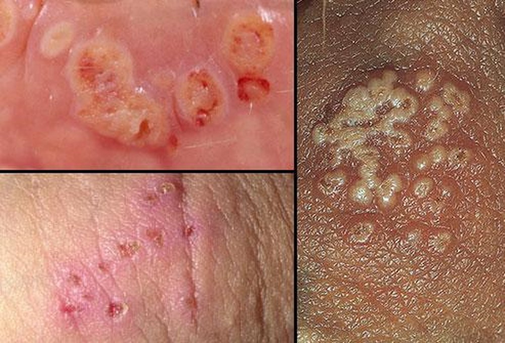 Bệnh ngoài da thường gặp ở vùng kín nam giới